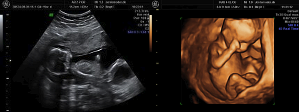 Scanning gravid uge 15