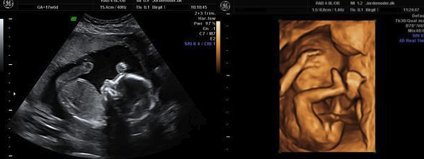 Gravid 17 uger Gravid uge