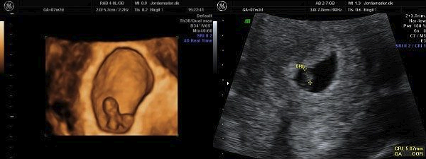 Gravid uge 8 Gravid uge