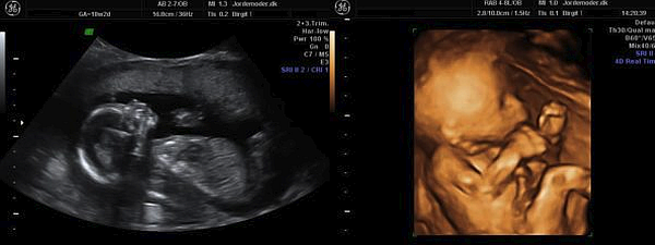 Gravid uge 18