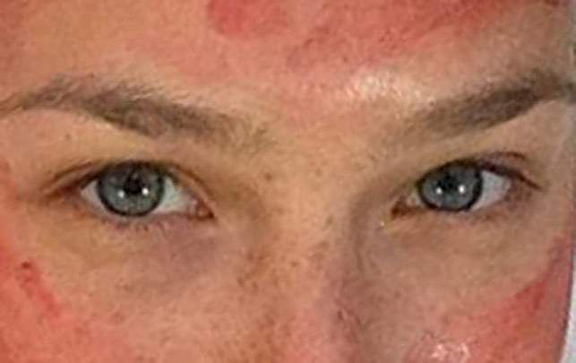 Hollywood stjernerne har kastet sig over de såkaldte vampyransigtsbehandlinger. blod ansigtsmaske