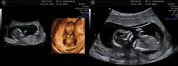 Scanning gravid uge 14