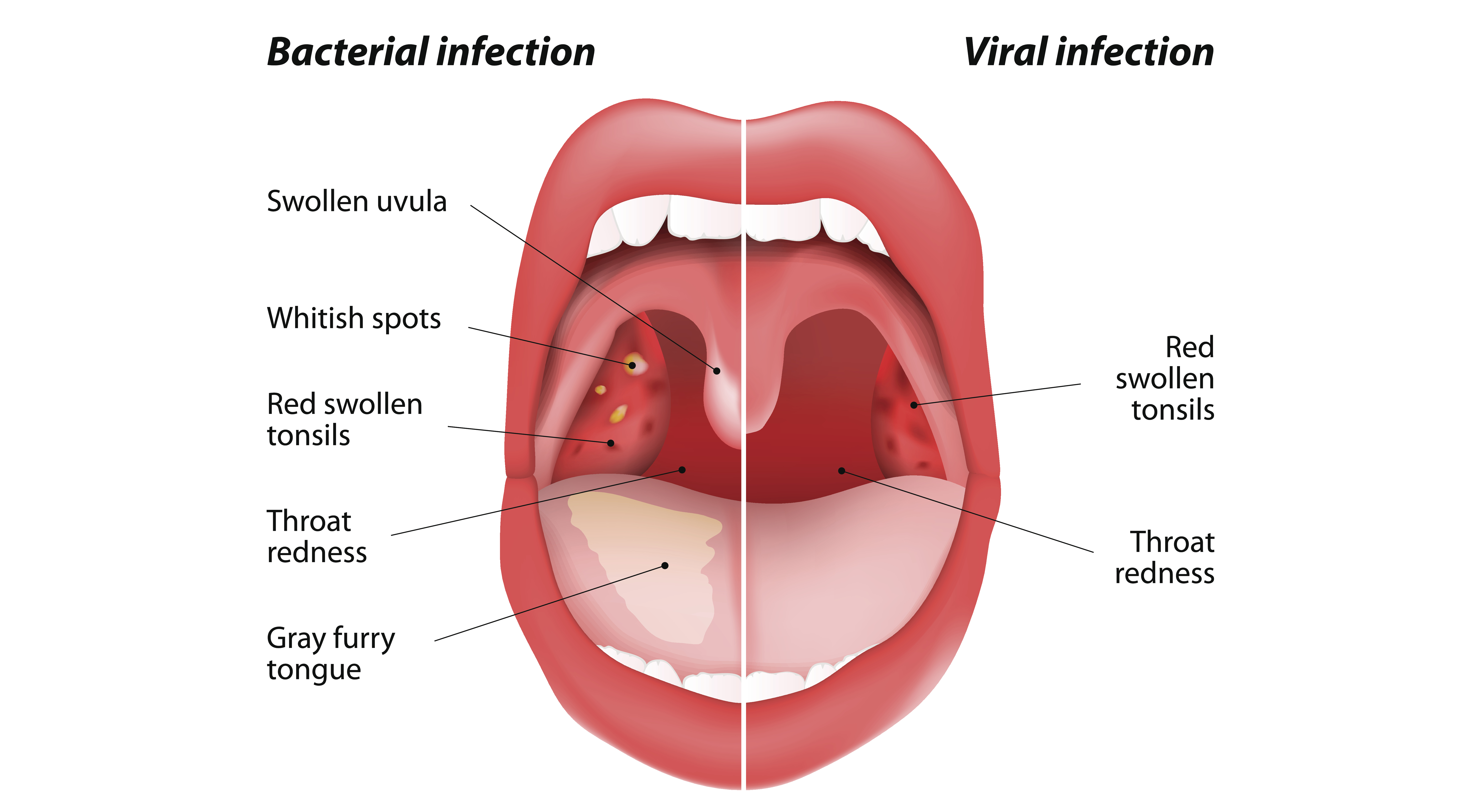 I munden symptomer kræft De mest