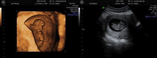 Scanning gravid uge 10